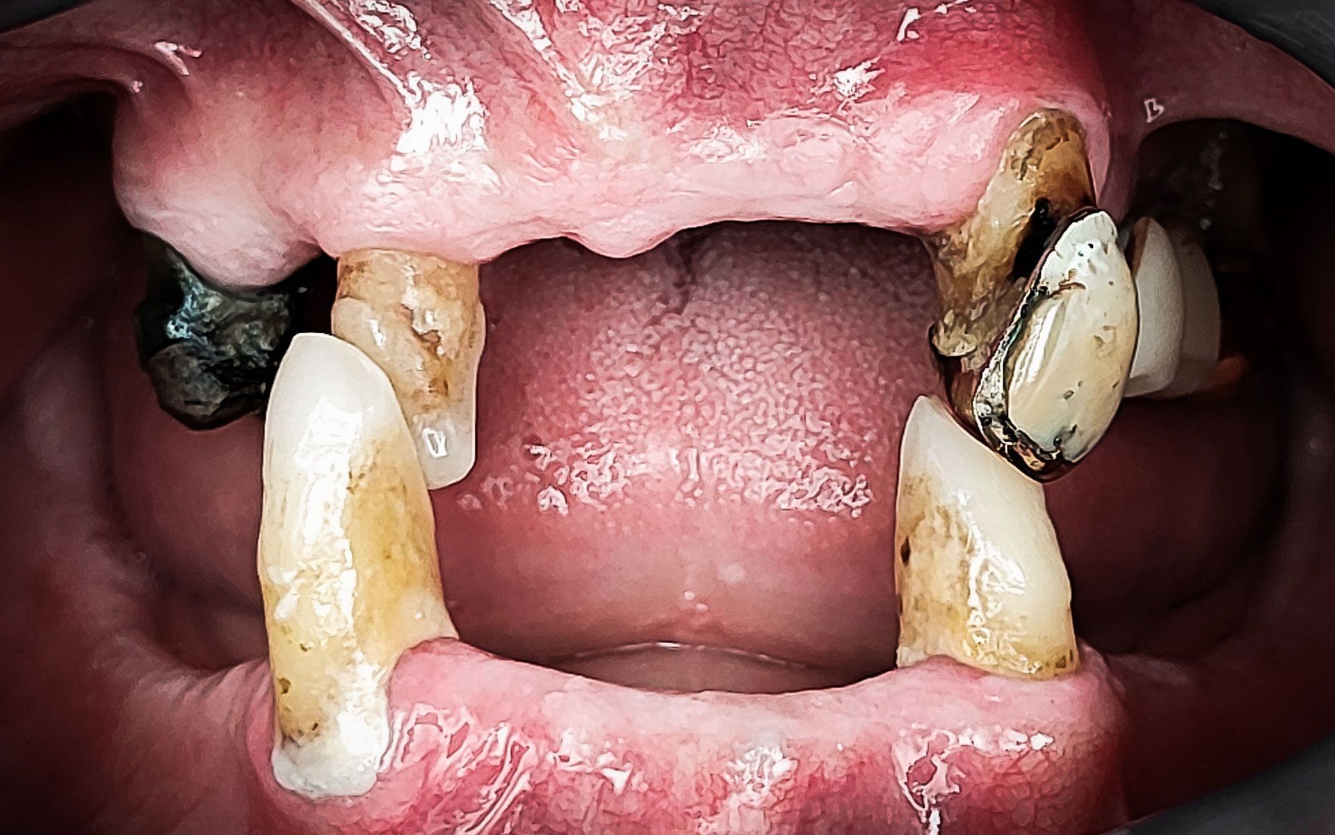 Primo piano della bocca di un cavallo che mostra denti mancanti e usurati con scolorimento marrone.