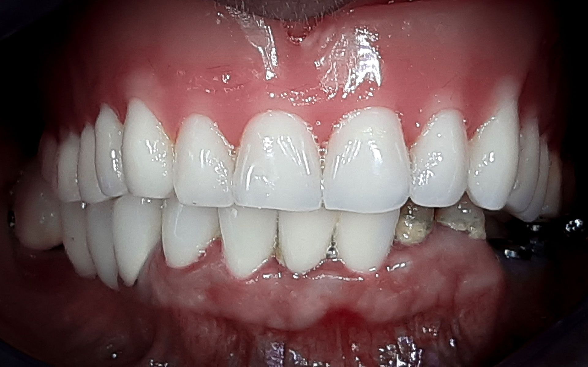 Primo piano della bocca sorridente di una persona che mostra denti e gengive bianchi.