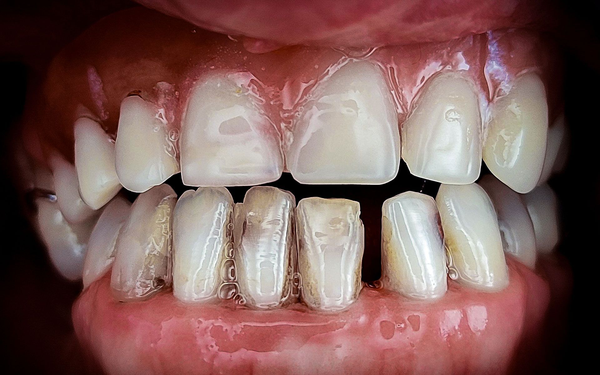 Primo piano di denti gravemente scoloriti e usurati, con danni visibili allo smalto e spazi vuoti.