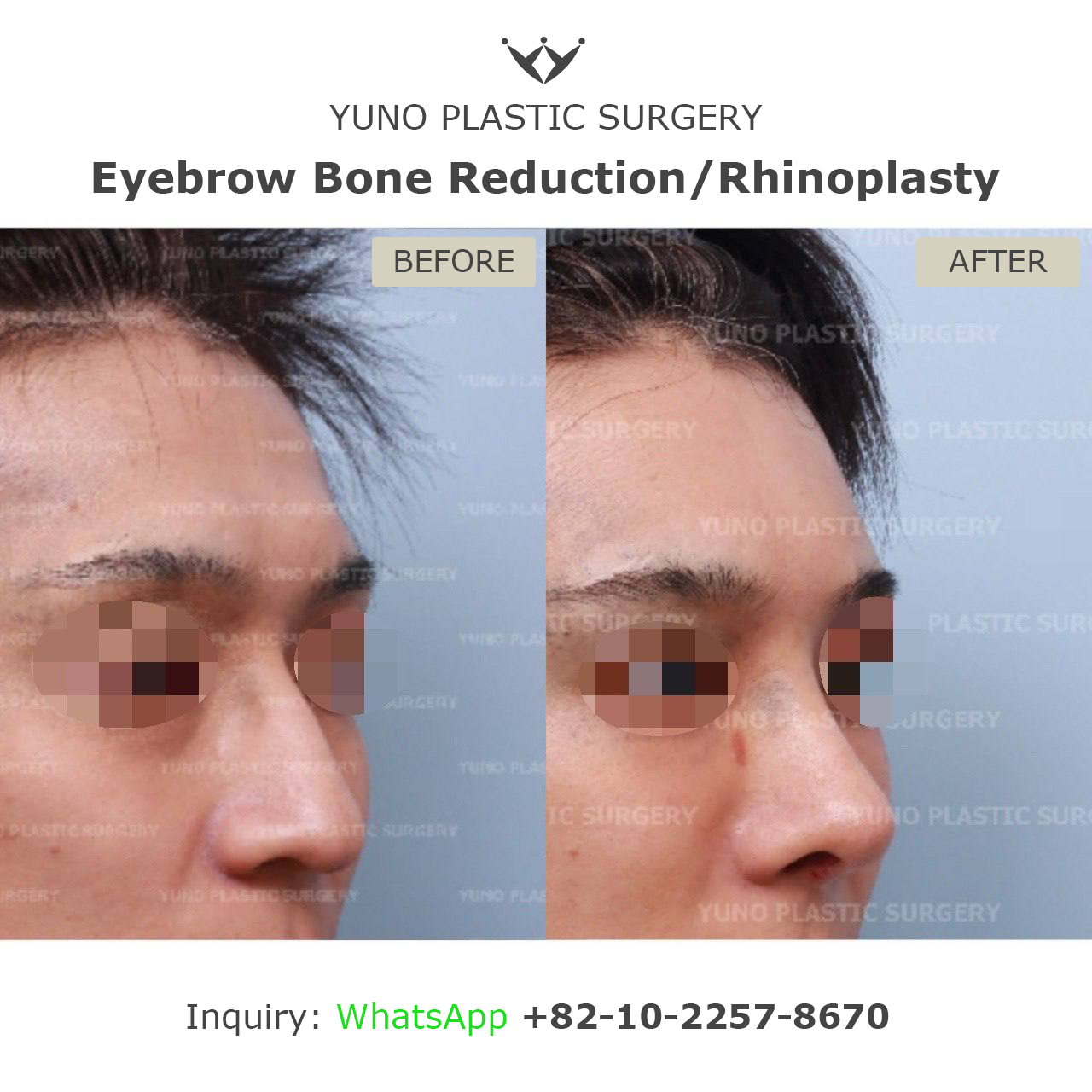 Eyebrow bone reduction with rhinoplasty before and after at YUNO Plastic Surgery, Gangnam, Seoul