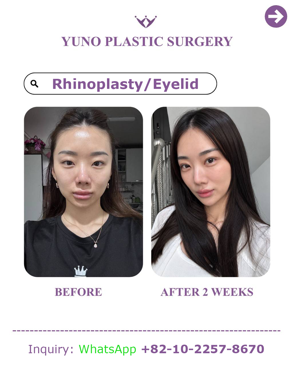 Rhinoplasty with eyelid surgery — 2 weeks after before and after at YUNO Plastic Surgery, Gangnam, Seoul