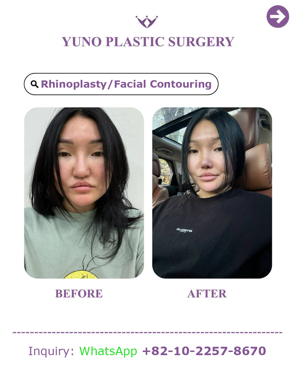 Rhinoplasty with facial contouring before and after at YUNO Plastic Surgery, Gangnam, Seoul