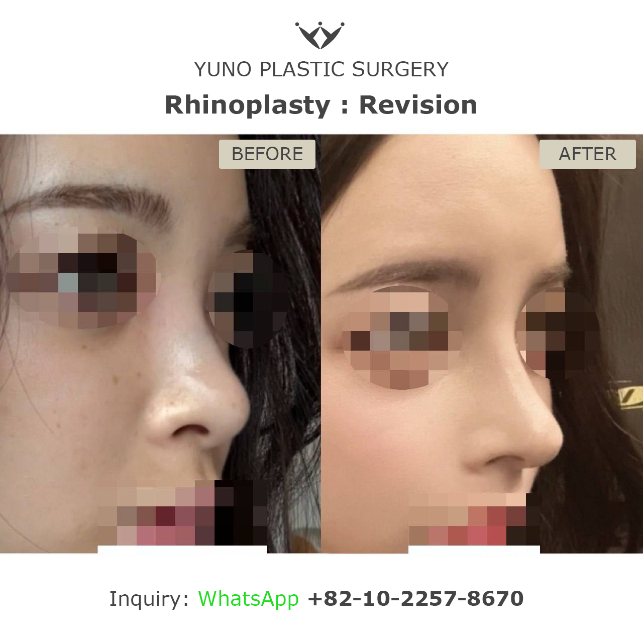 Revision rhinoplasty — side profile before and after at YUNO Plastic Surgery, Gangnam, Seoul