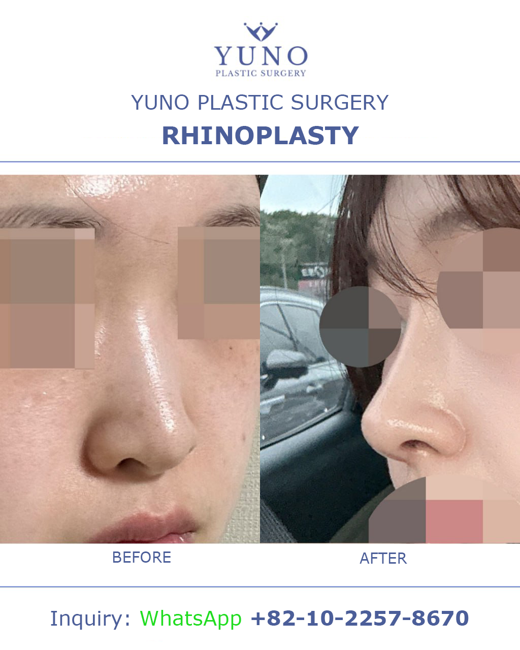 Rhinoplasty — front and side views before and after at YUNO Plastic Surgery, Gangnam, Seoul