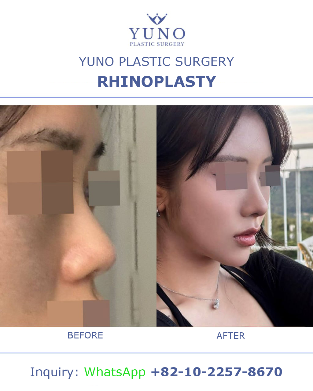 Rhinoplasty — side profile before and after at YUNO Plastic Surgery, Gangnam, Seoul