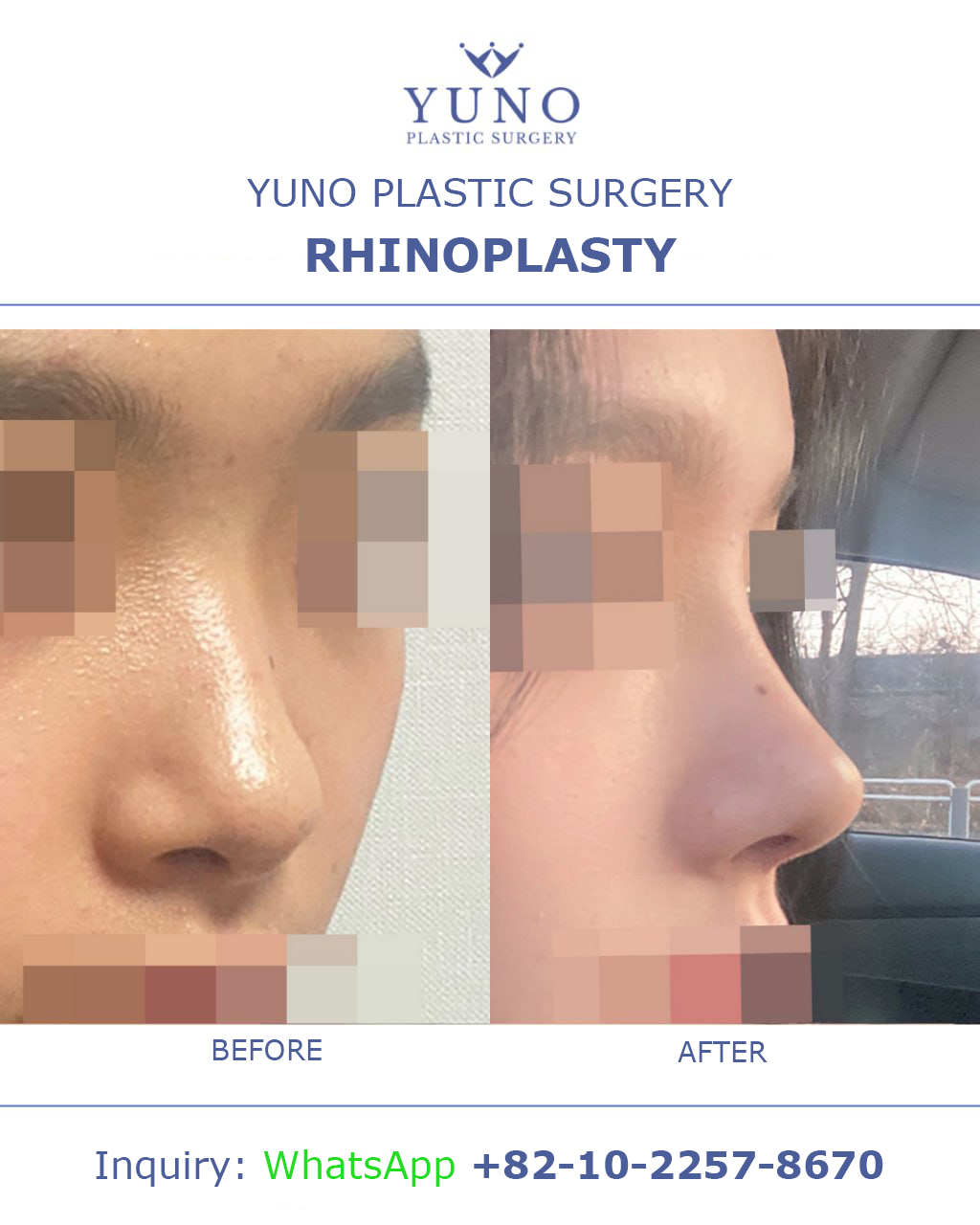 Rhinoplasty — close-up oblique view before and after at YUNO Plastic Surgery, Gangnam, Seoul