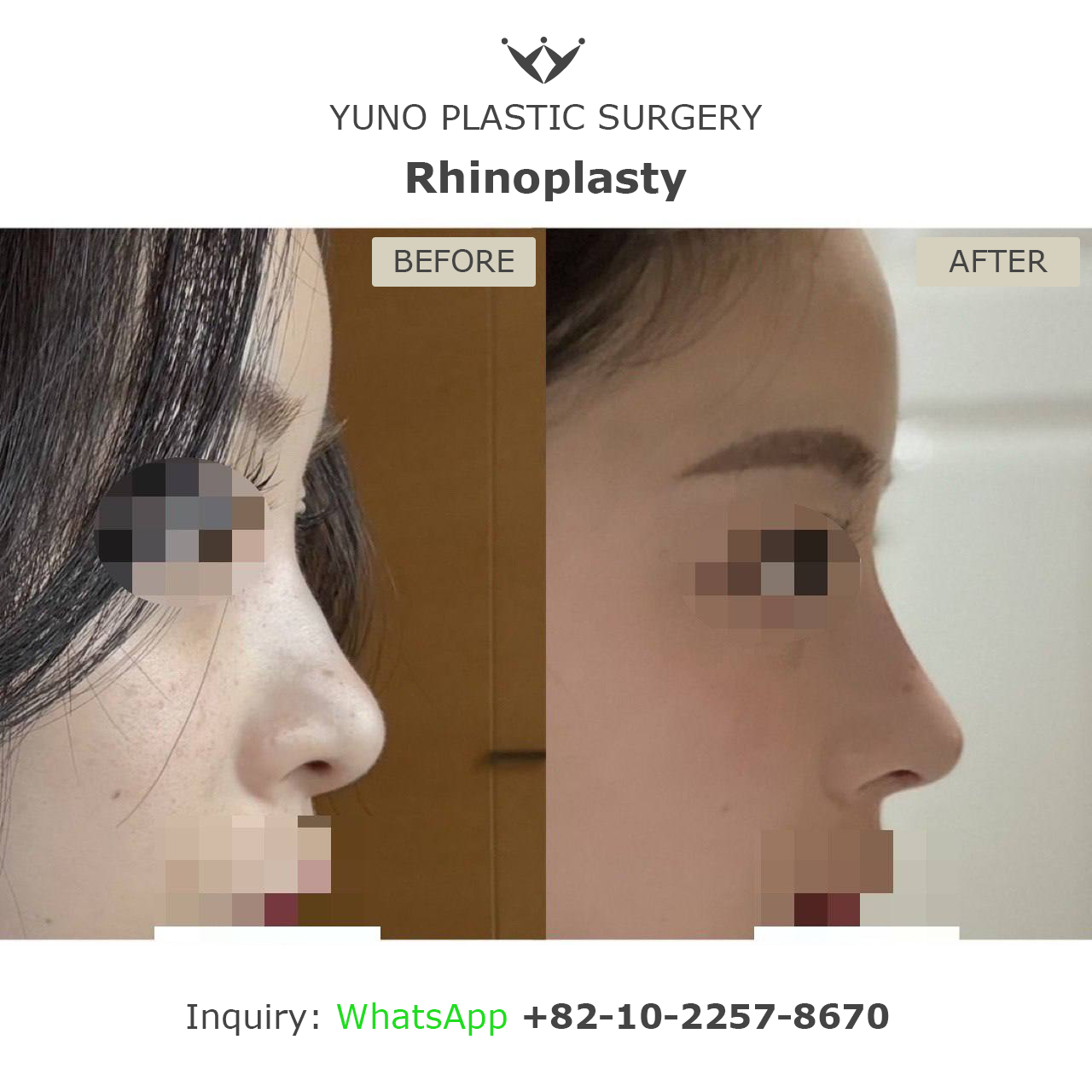 Rhinoplasty — side profile before and after at YUNO Plastic Surgery, Gangnam, Seoul