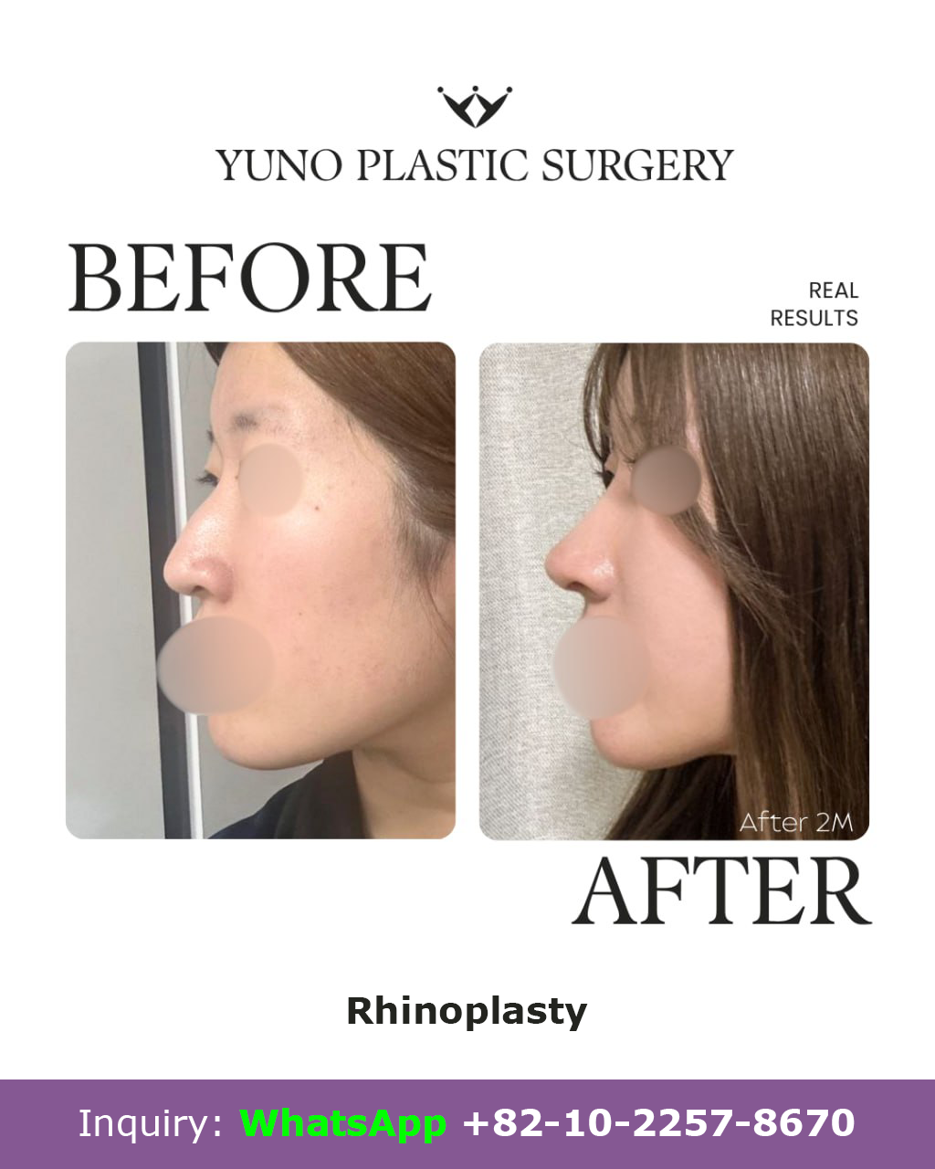 Rhinoplasty — side profile, 2 months after before and after at YUNO Plastic Surgery, Gangnam, Seoul