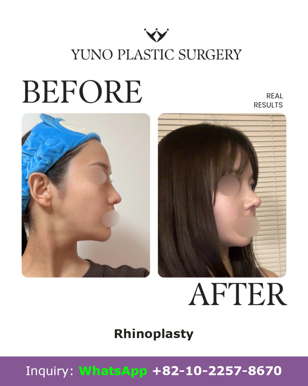 Rhinoplasty — side profile before and after at YUNO Plastic Surgery, Gangnam, Seoul