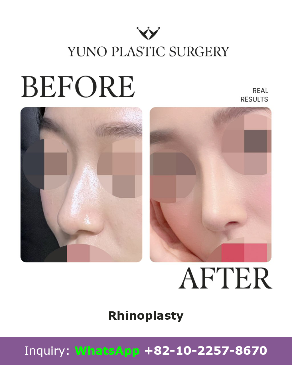 Rhinoplasty — oblique view before and after at YUNO Plastic Surgery, Gangnam, Seoul