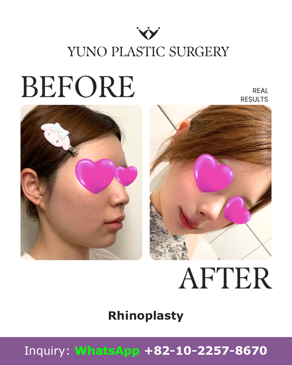 Rhinoplasty — oblique view before and after at YUNO Plastic Surgery, Gangnam, Seoul