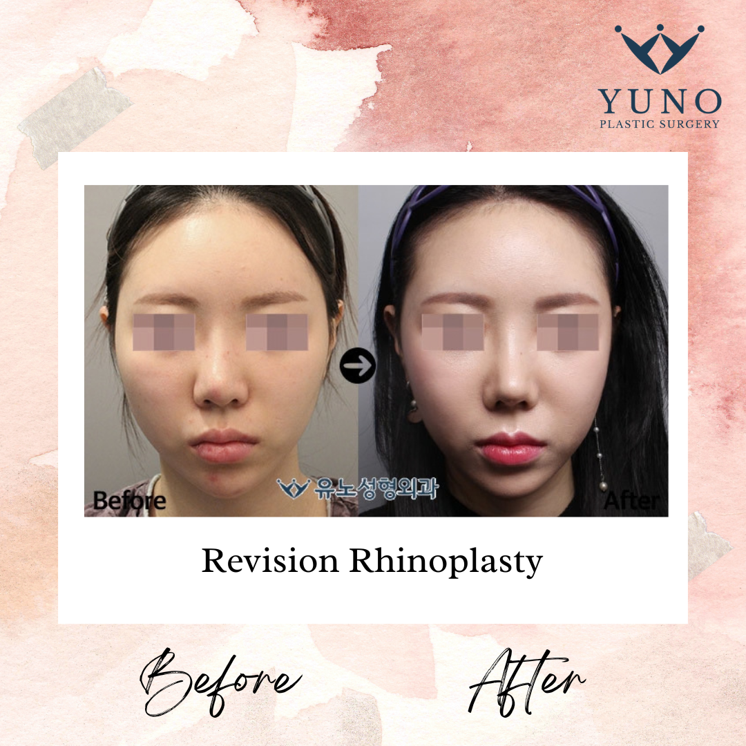 Revision rhinoplasty — front view before and after at YUNO Plastic Surgery, Gangnam, Seoul