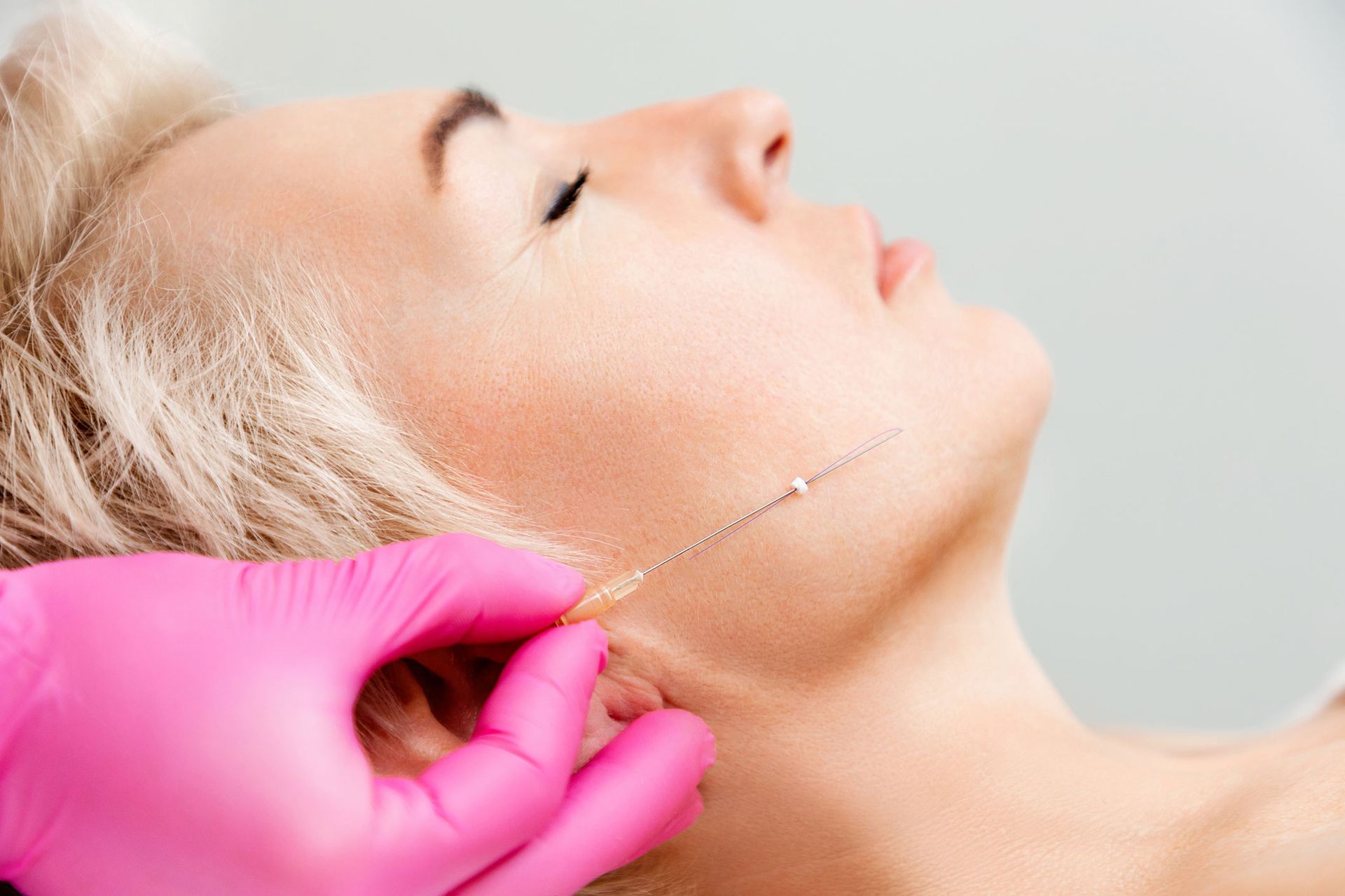 Person receiving cosmetic thread lift, pink gloved hand. Person receiving cosmetic thread lift, pink gloved hand.