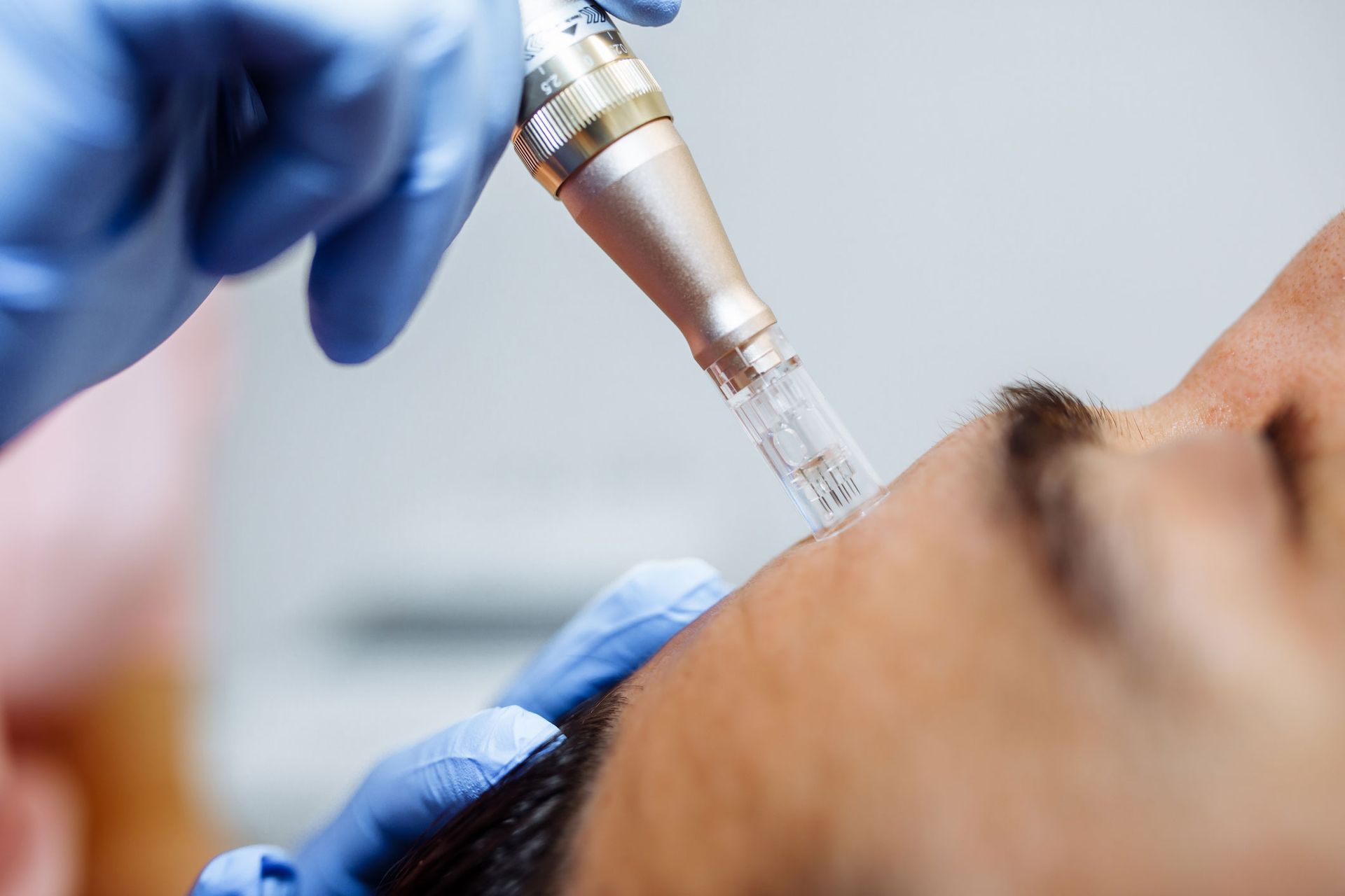 Person receiving microneedling treatment on the forehead, held by gloved hands. Person receiving microneedling treatment on the forehead, held by gloved hands.