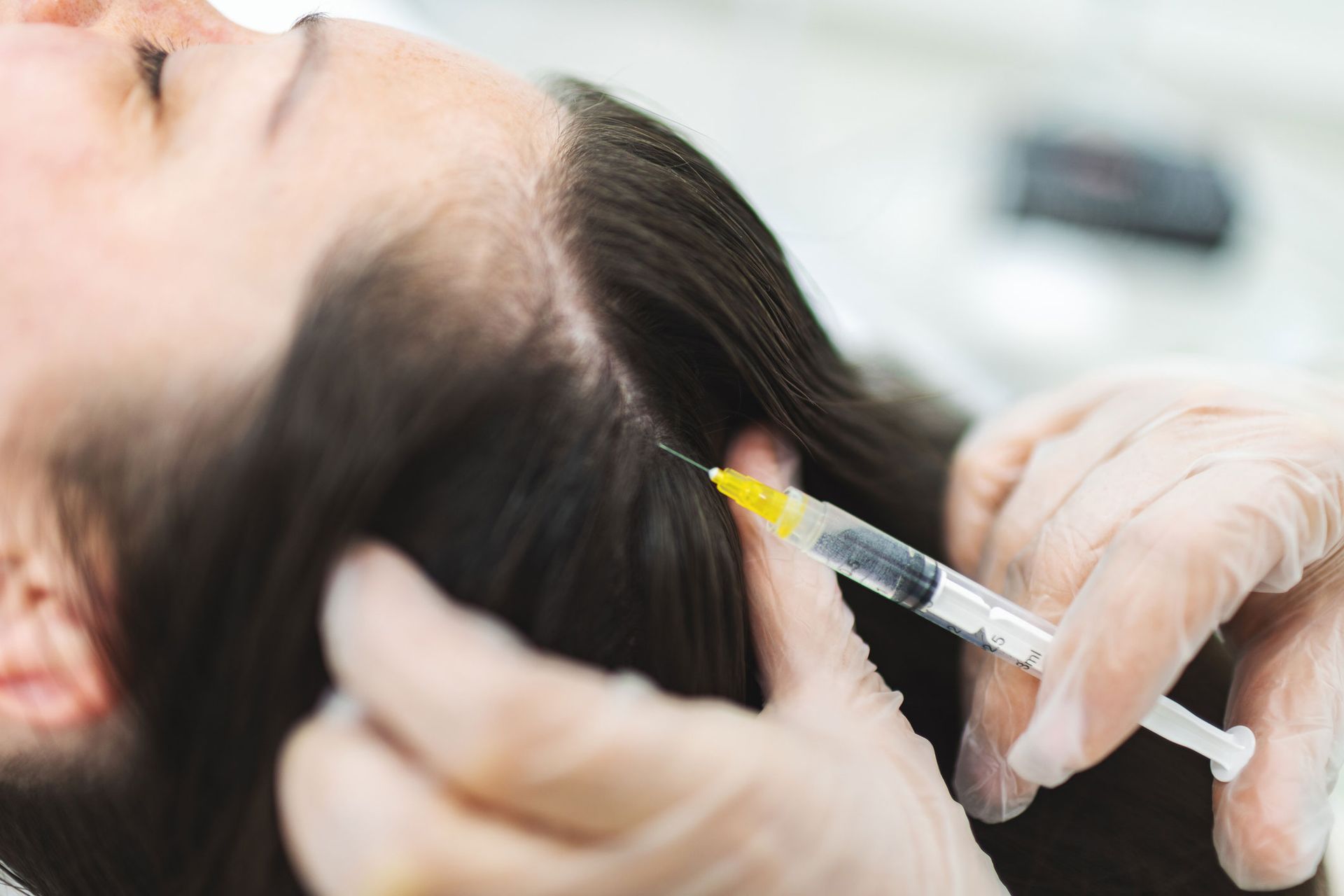 A gloved hand injects a liquid into a person's scalp, near parted brown hair, in a clinical setting. A gloved hand injects a liquid into a person's scalp, near parted brown hair, in a clinical setting.