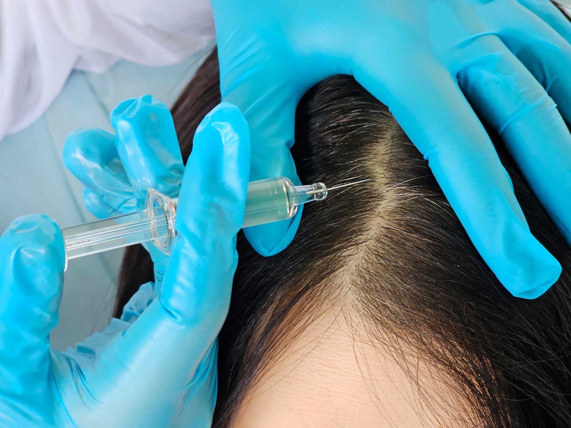 Person receiving scalp injections from someone wearing blue gloves. Person receiving scalp injections from someone wearing blue gloves.