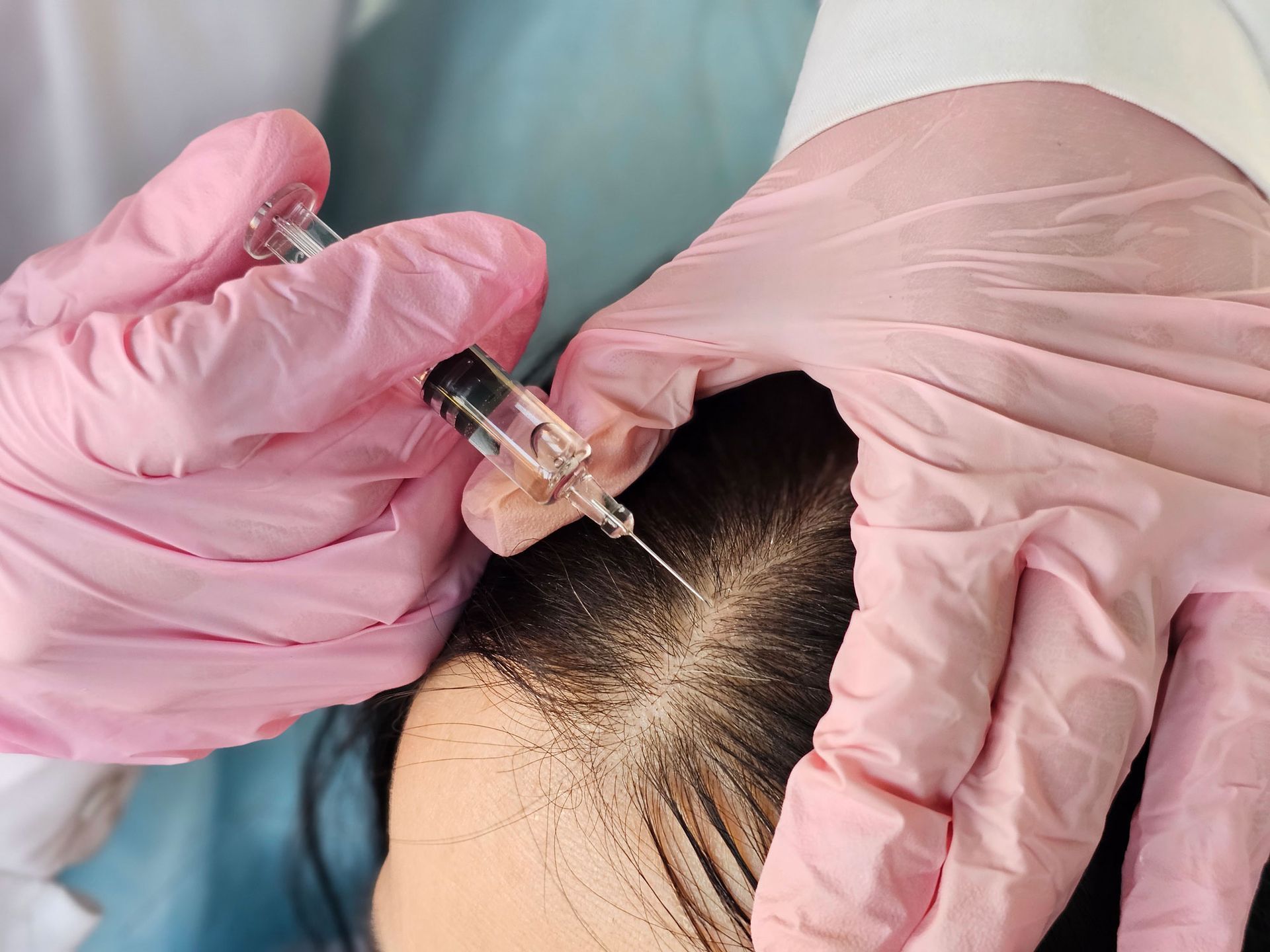 Person receiving injection to scalp. Pink-gloved hands hold syringe near head with visible hair thinning. Person receiving injection to scalp. Pink-gloved hands hold syringe near head with visible hair thinning.