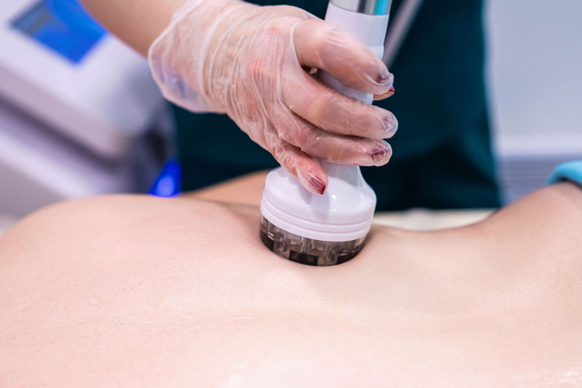 Gloved hand using a device on a person's back, likely for a body treatment. Gloved hand using a device on a person's back, likely for a body treatment.
