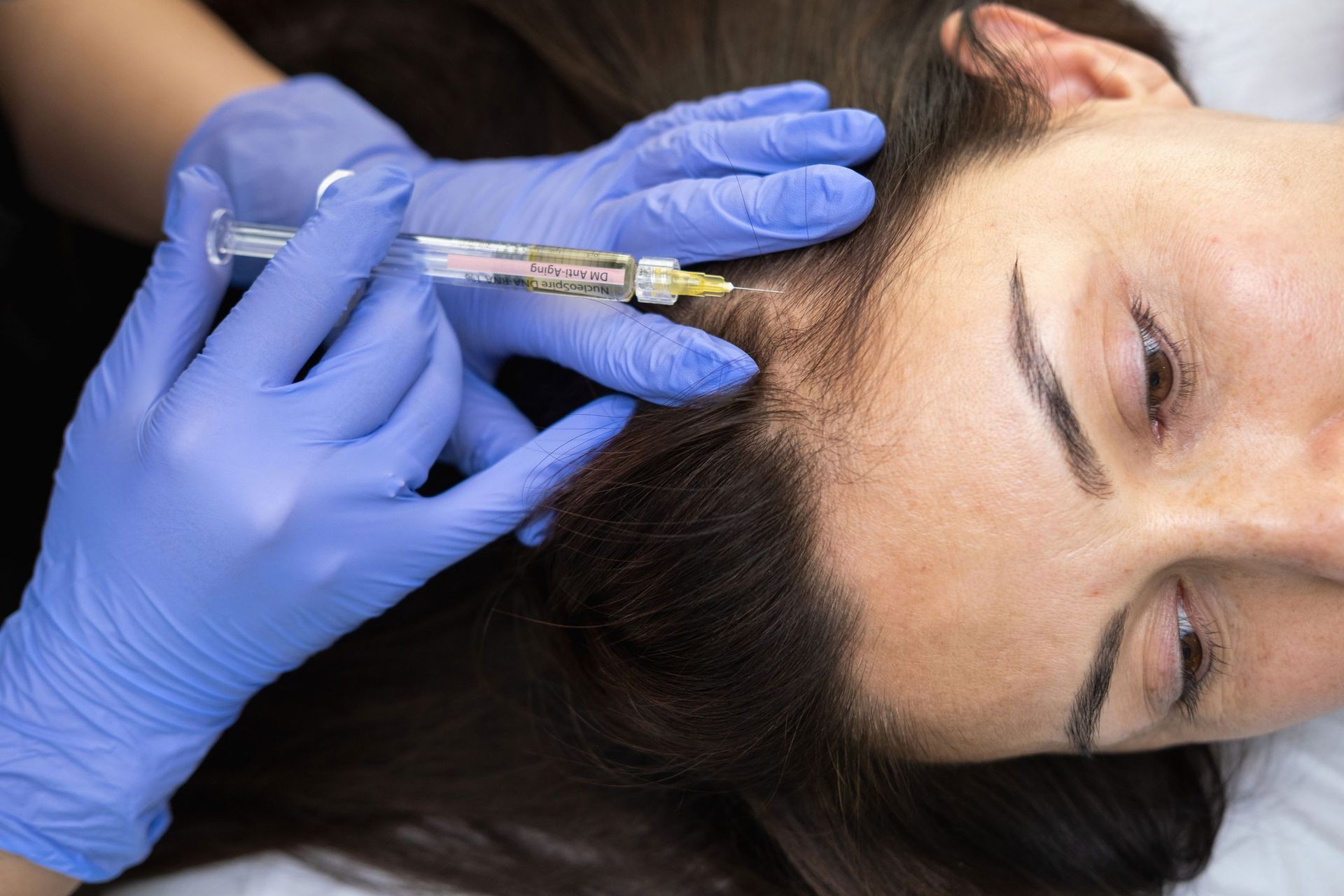 Person receiving an injection in their scalp by a gloved hand. Syringe and blue gloves visible. Person receiving an injection in their scalp by a gloved hand. Syringe and blue gloves visible.