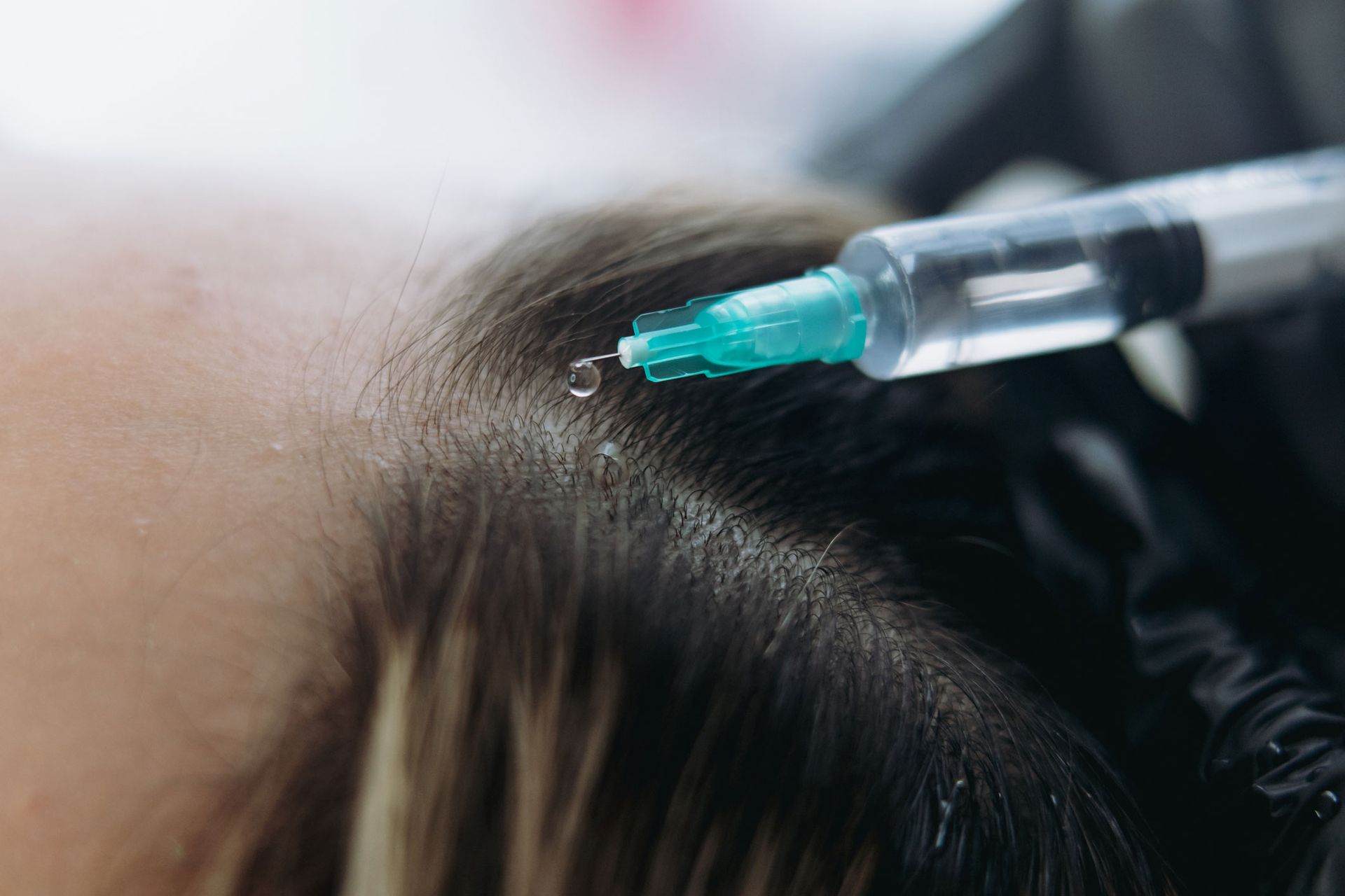 Syringe injecting liquid into scalp, close-up. Syringe injecting liquid into scalp, close-up.