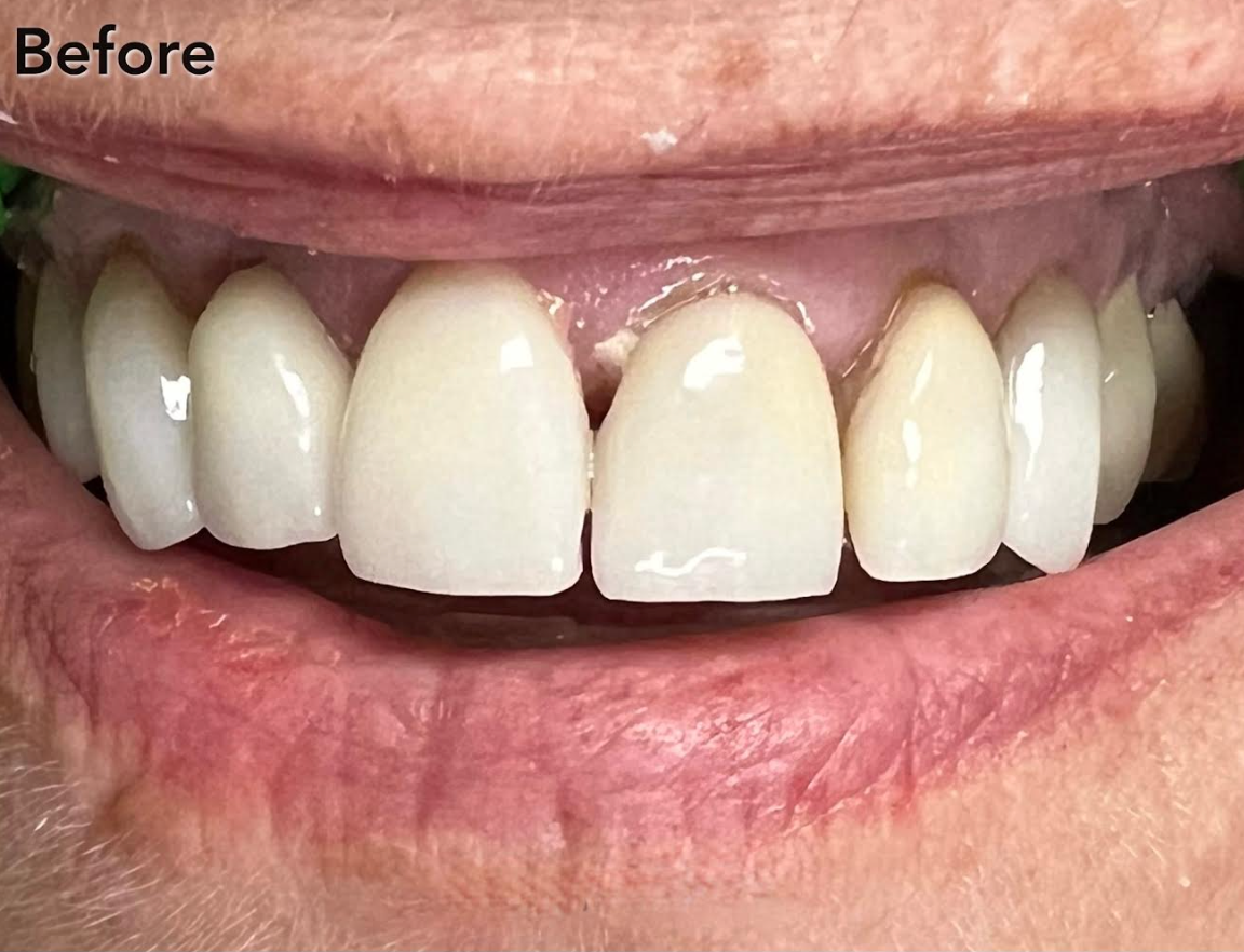 A close up of a woman 's smile with white teeth.