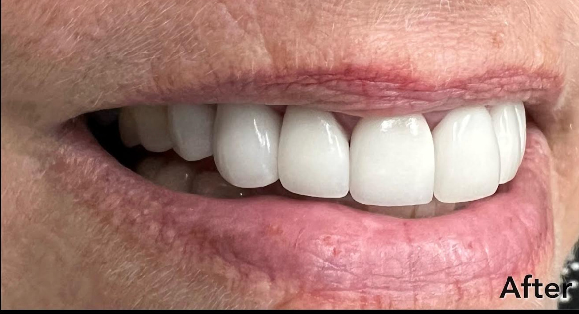 A close up of a woman 's smile with white teeth.