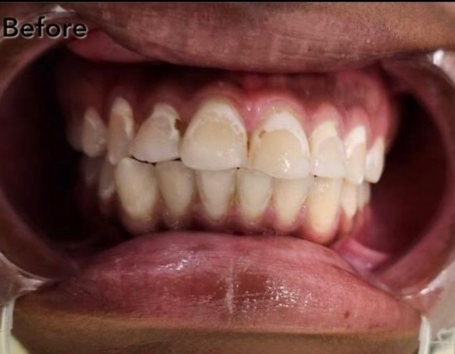 A close up of a woman 's smile with white teeth and red lips.