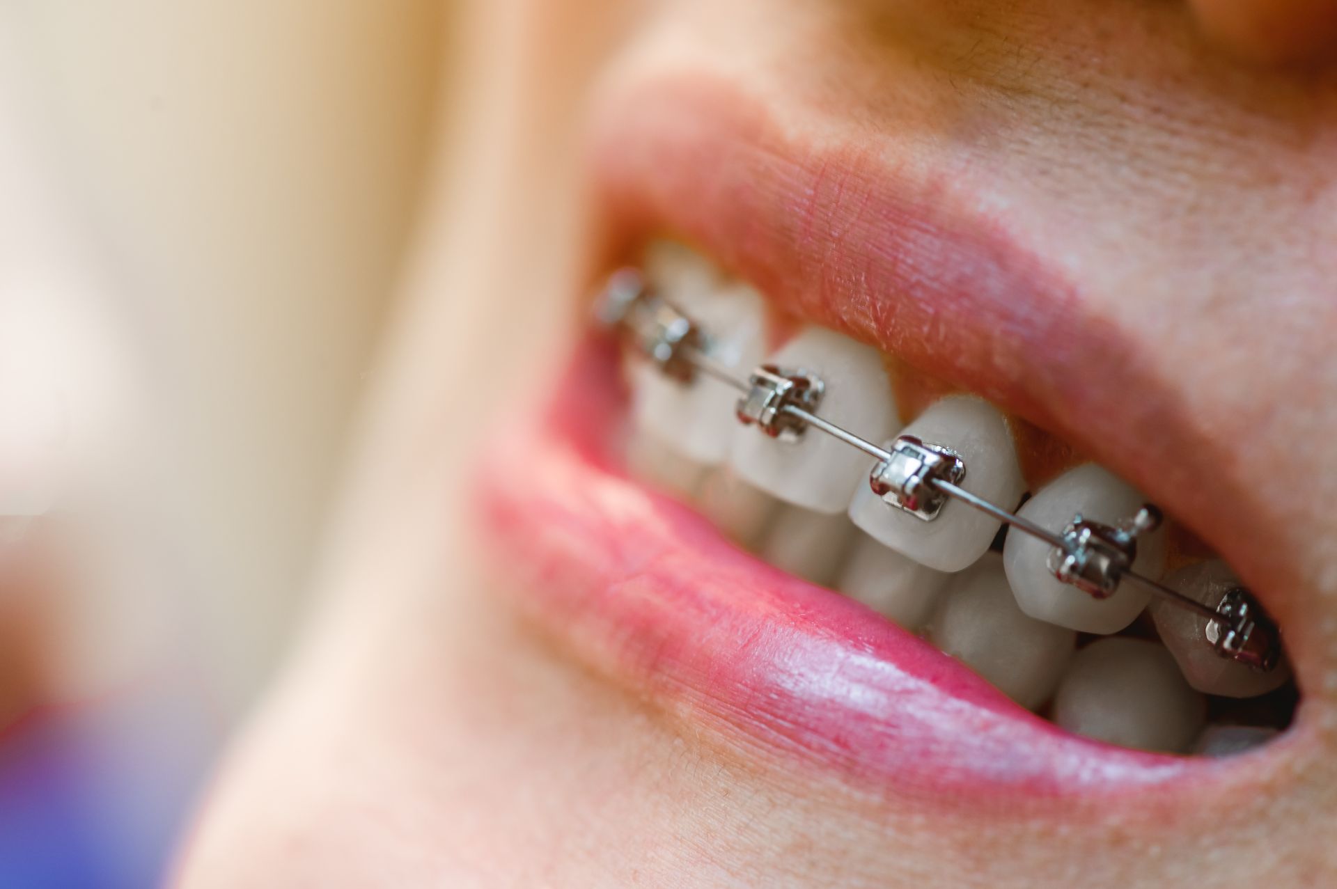 Close-up of a smiling mouth with silver braces on the teeth