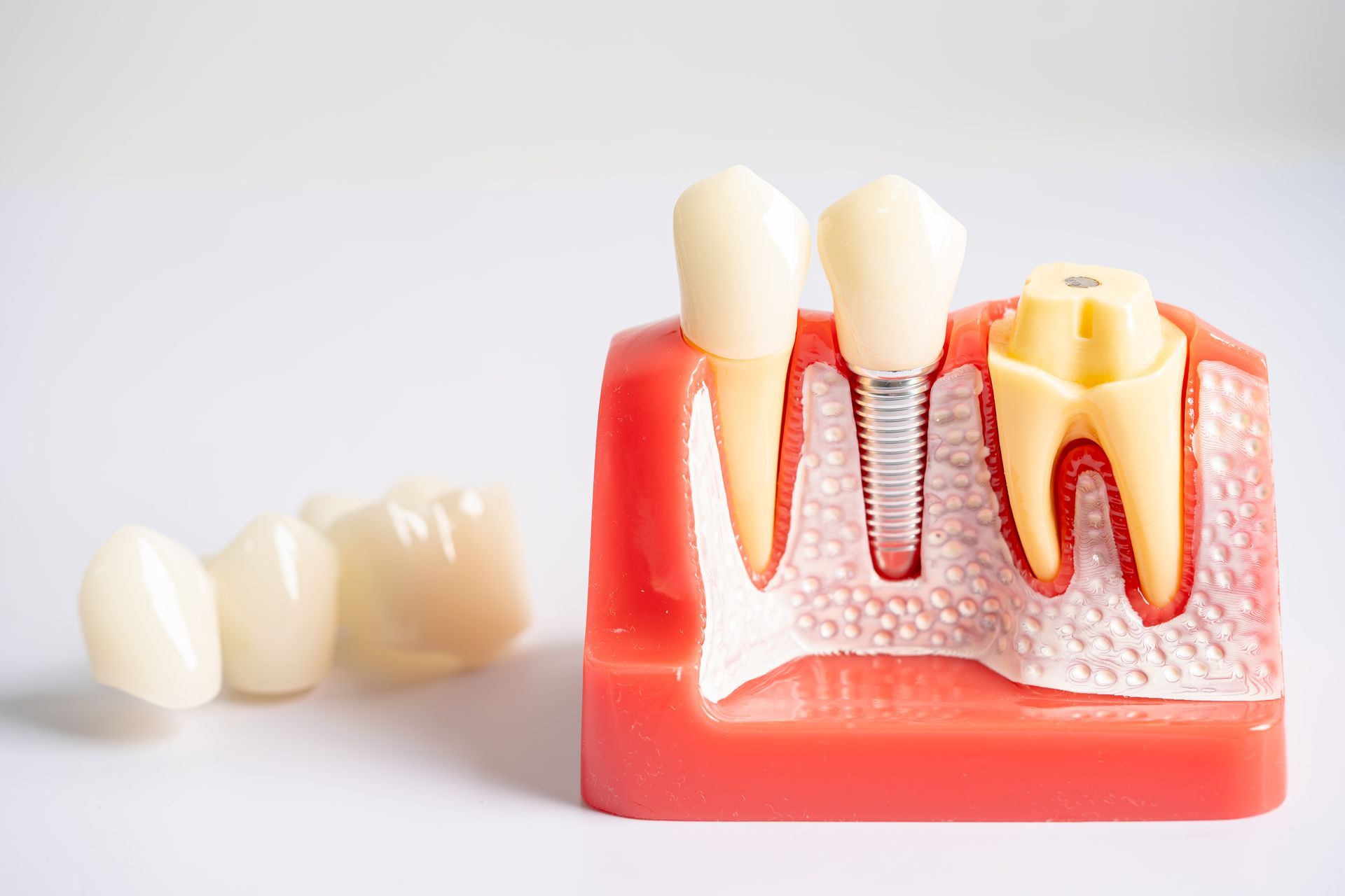 Dental implant model with two teeth implants in pink gum and a loose white dental crown beside it