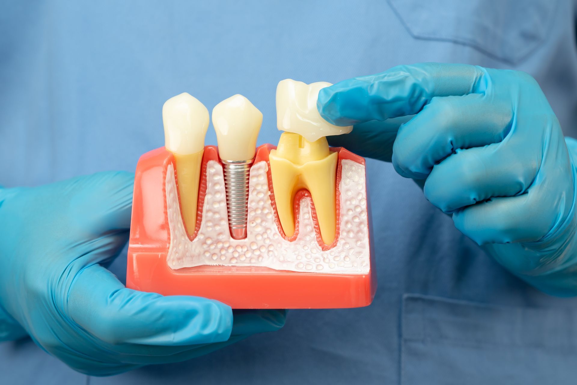Gloved hands holding a dental implant model with teeth and gum sections