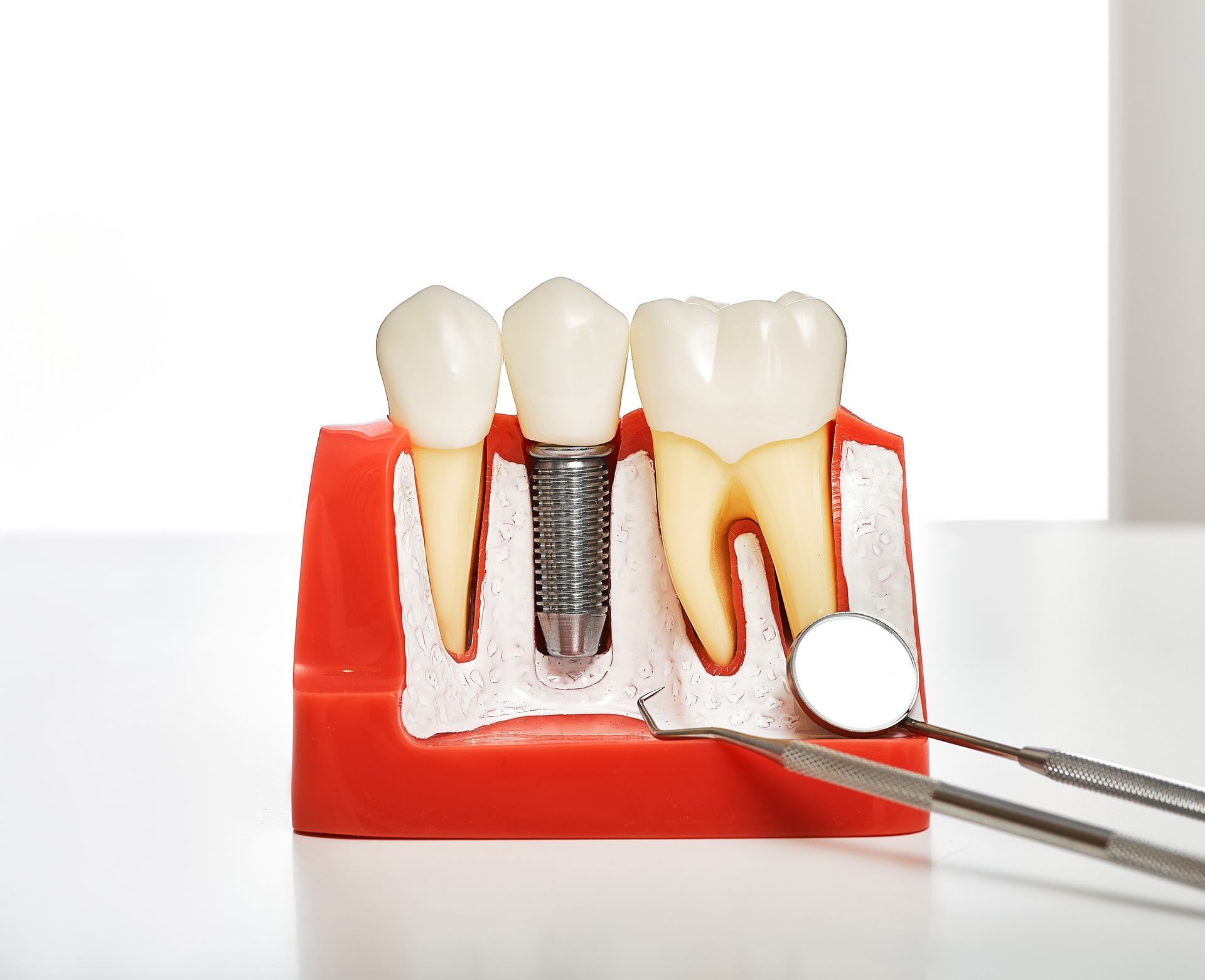 Dental model showing a tooth implant between two natural teeth, with dental tools in the foreground.