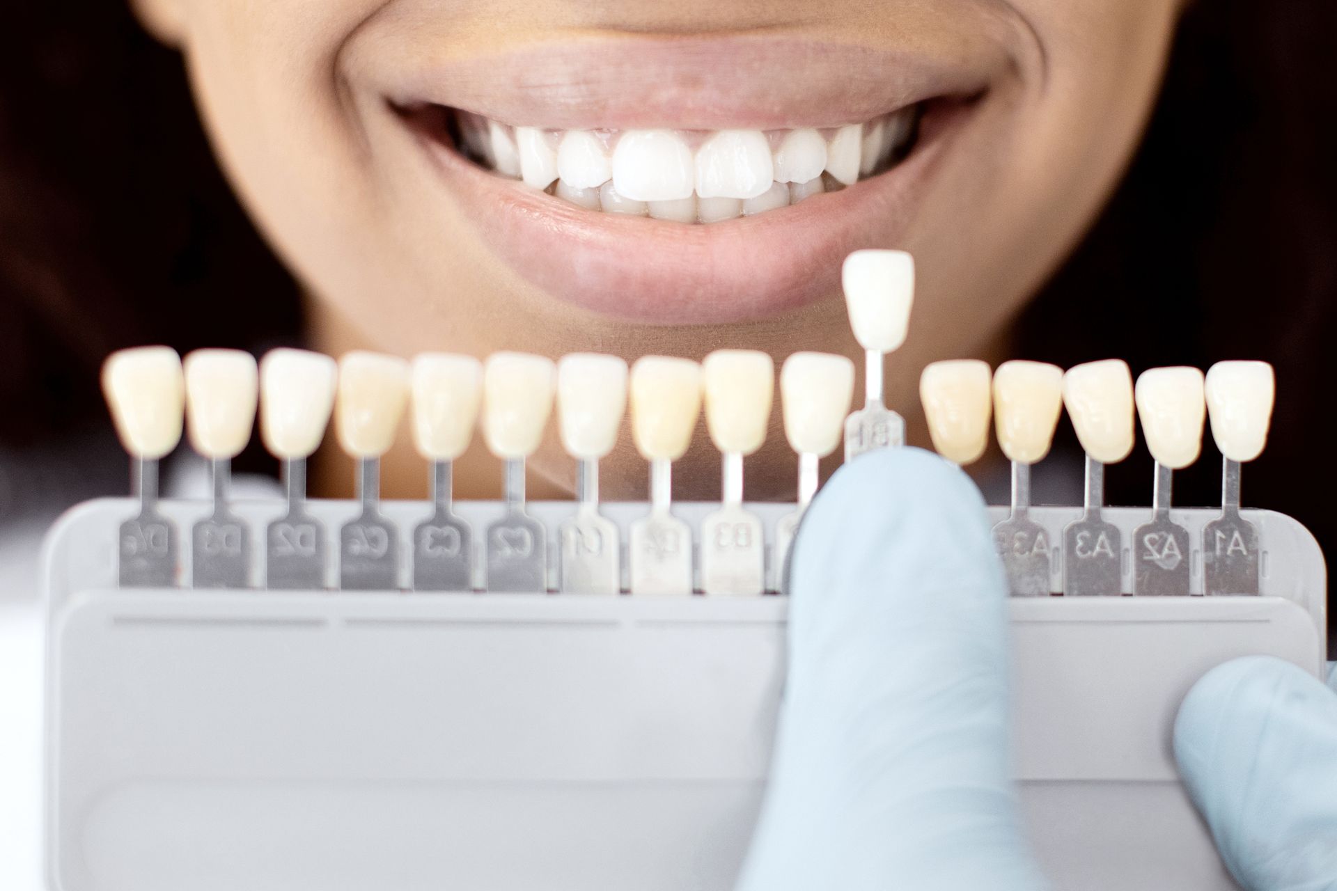 Gloved hands comparing tooth shades to a smiling mouth with dental veneer samples