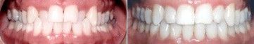 Close-up of a mouth showing teeth before and after whitening treatment side by side