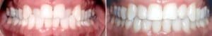 Crossbite