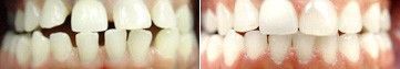 Close-up of teeth before and after whitening, showing yellowed teeth next to brighter white teeth.