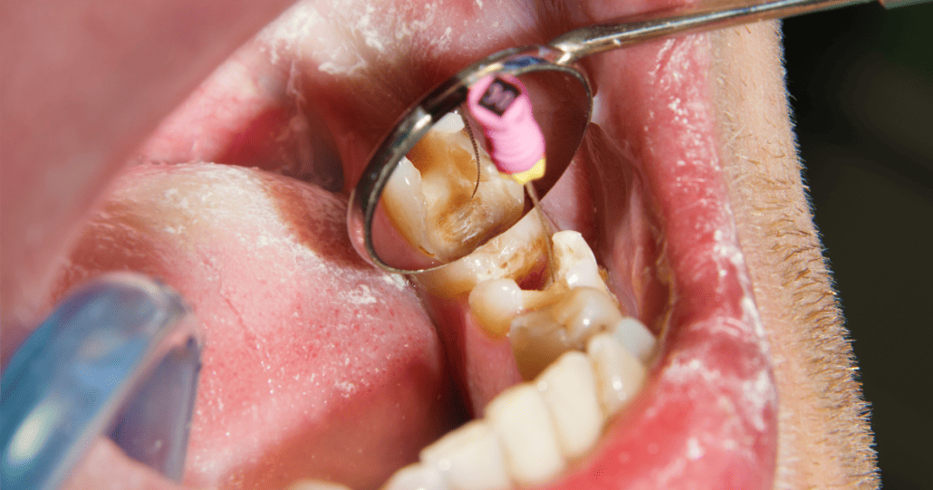 my fillings 