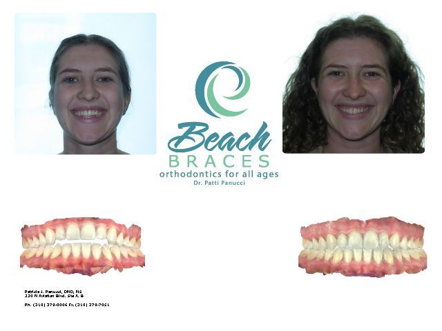 Orthodontic before-and-after smile comparison with Beach Braces logo and teeth models