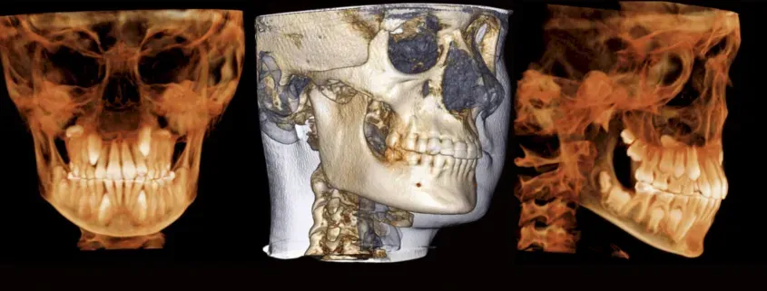 Three skulls shown side by side, one in a gray 3D scan between two brown skull renders.