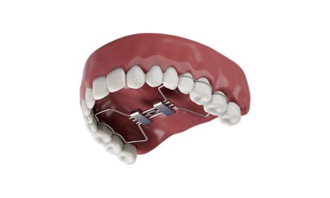 3D dental appliance with metal springs inside an upper jaw model