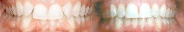 Close-up of teeth with redness around the gums, shown in a side-by-side comparison.
