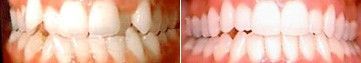 Close-up of teeth with a visible gap and a comparison between before and after whitening or alignment results