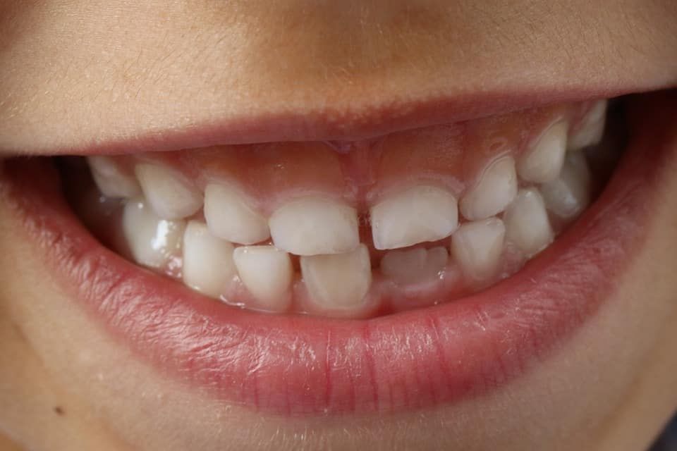Child's teeth