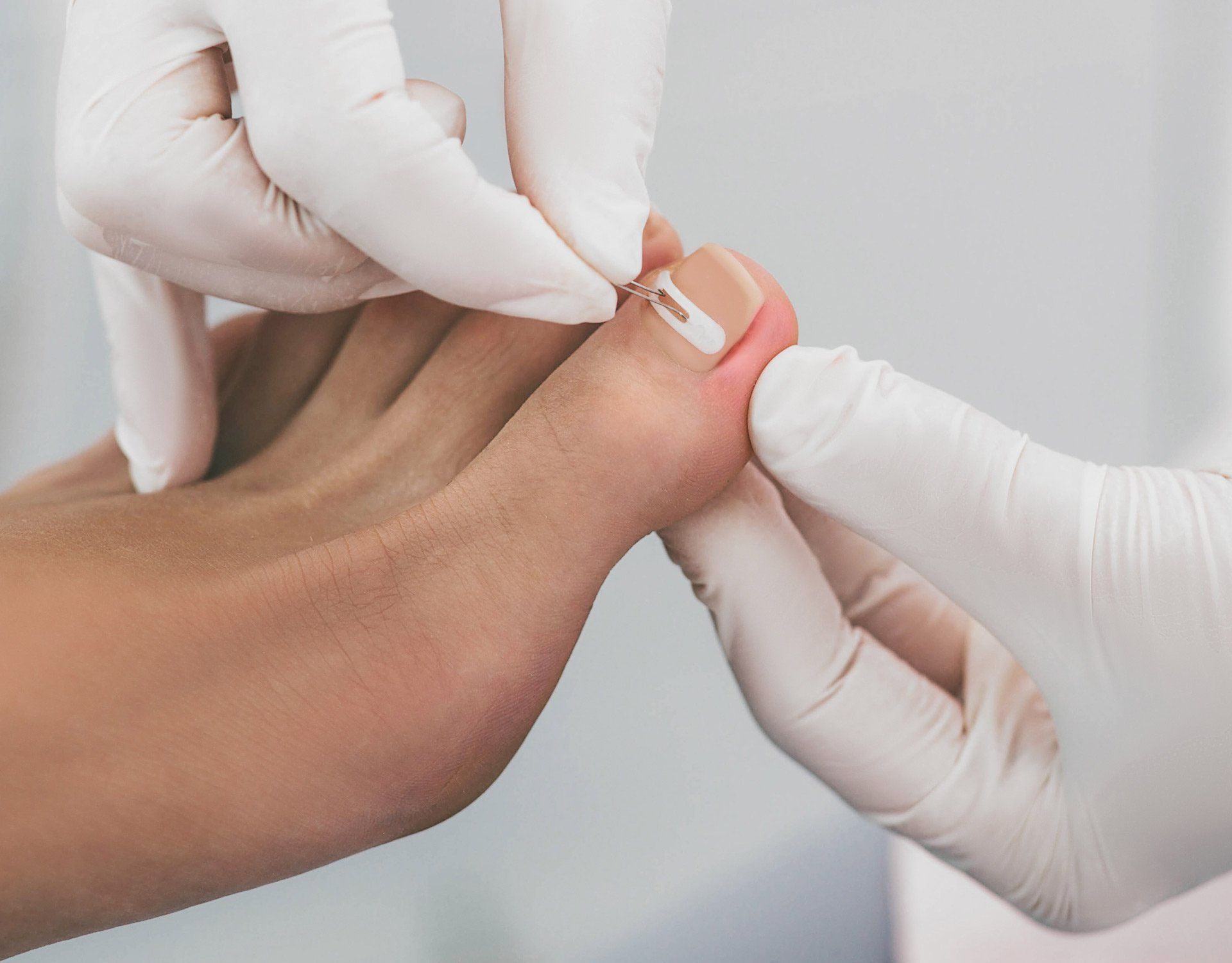 Doctor Podiatry Treats Ingrown Nails | Central Coast, Nsw | Angela Green Podiatry