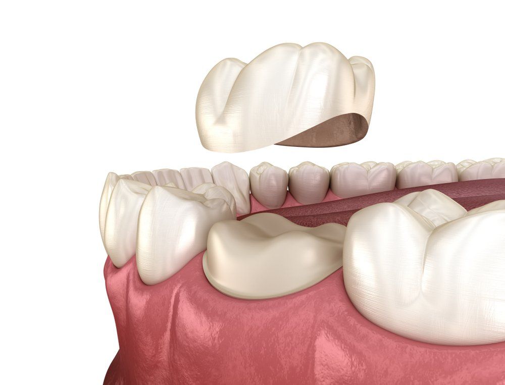 Rendering Of Crown Installation — Dentistry Services in Cairns, QLD