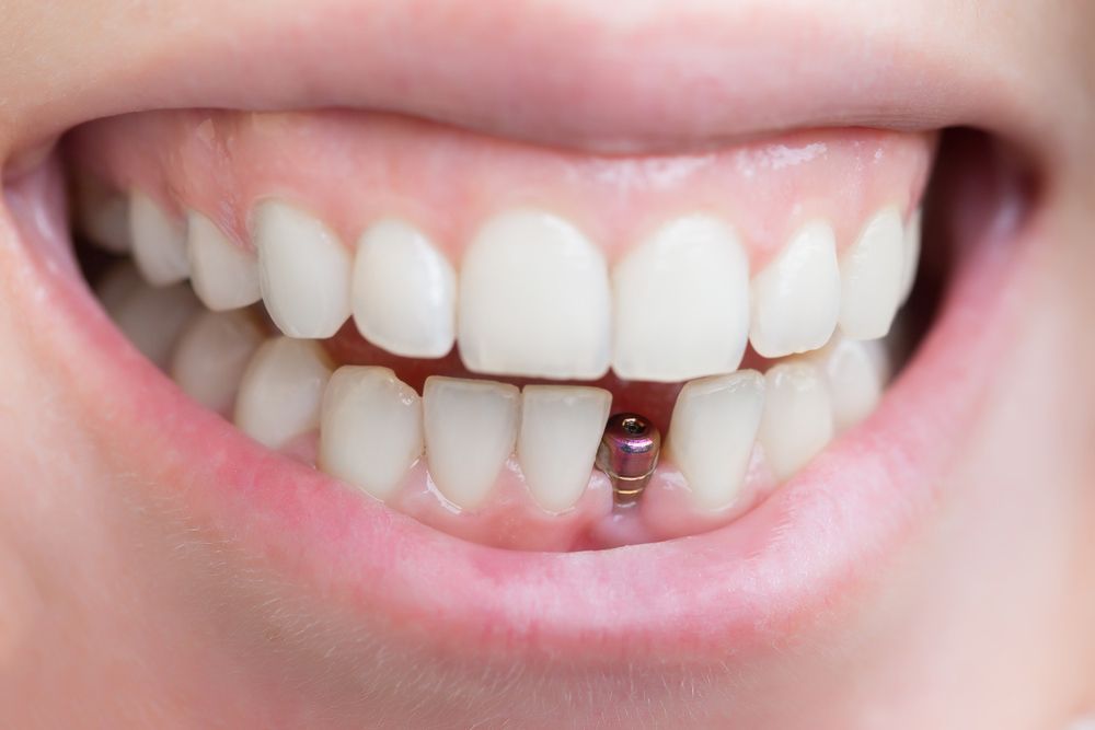 Closer Look At A Dental Implant Tooth Denture