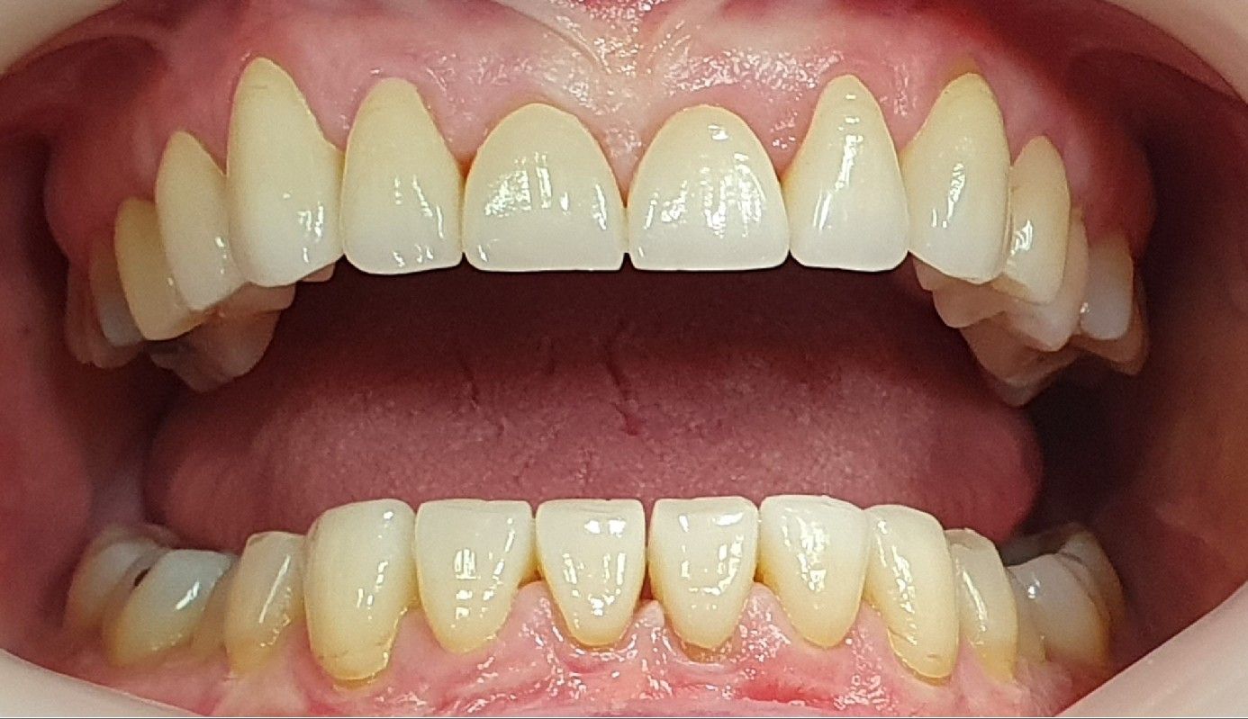 Open mouth showing upper and lower teeth and pink gums