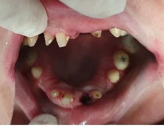 Open mouth with severe tooth decay, missing teeth, and inflamed gums