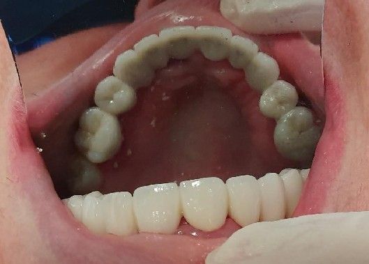 Open mouth showing upper dental arch with white teeth and pink gums, held open by gloved fingers