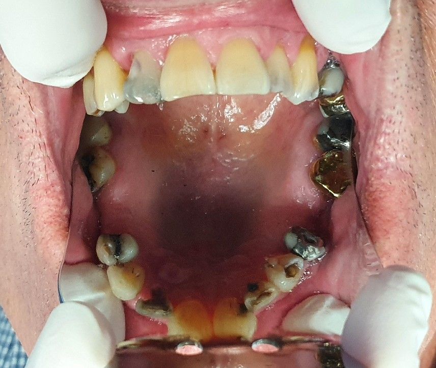 Open mouth showing upper and lower teeth with dark staining and discoloration on gums and palate
