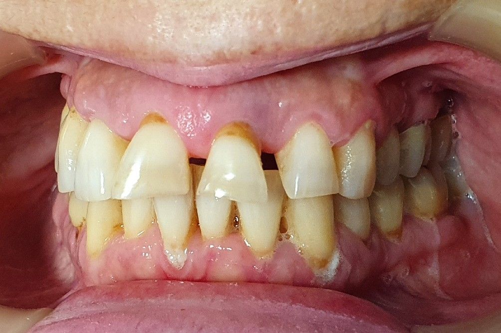 Dental Before - The Dentist Cairns Dental Group